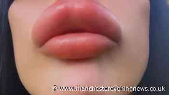 'I want to look like I've gone too far': Manchester woman ignores urgent warnings from professionals over lip filler
