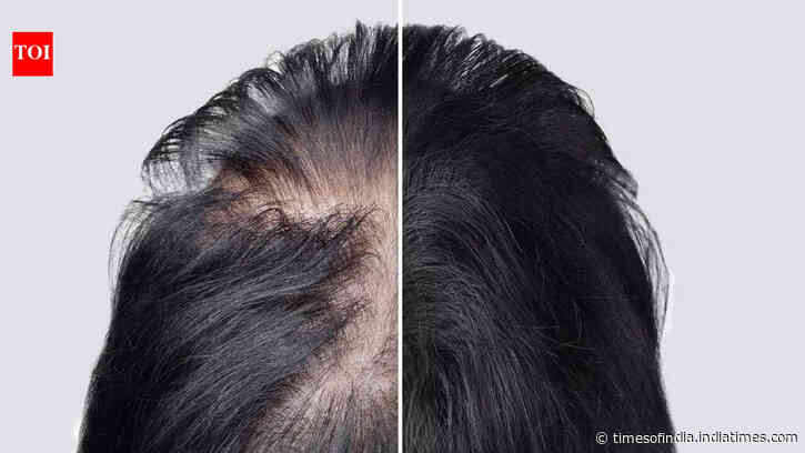 Losing hair because of Alopecia? This Arthritis drug can help you regrow hair like never before