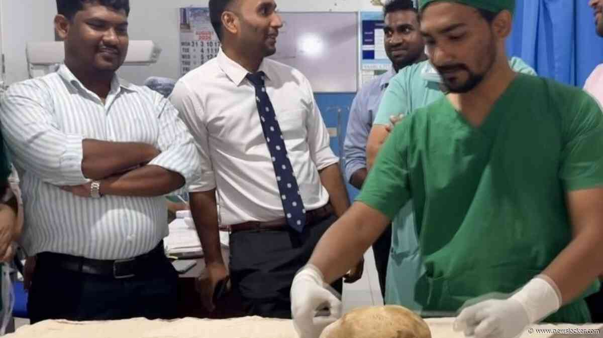 Chirurgen verwijderen blaassteen van 3,1 kilo in Sri Lanka, mogelijk een wereldrecord