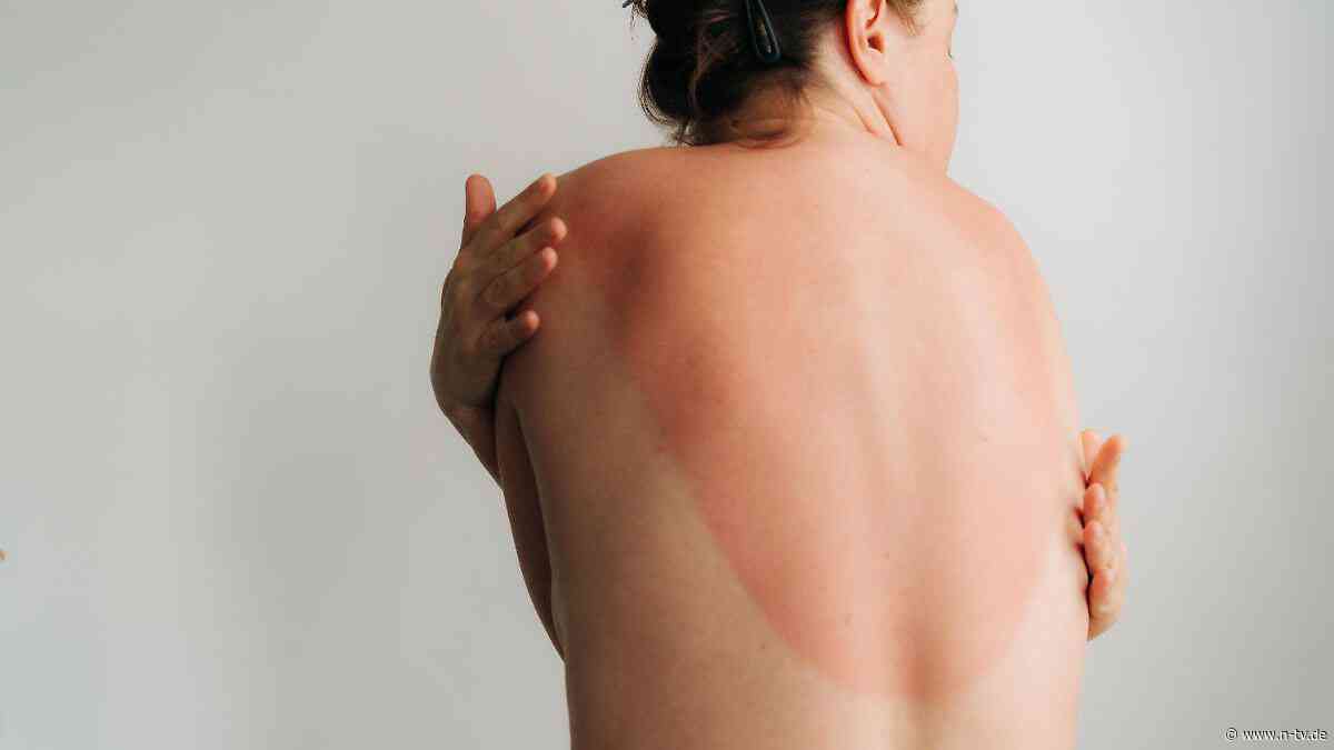 Krebsrisiko durch UV-Strahlung: Bereits ein einziger Sonnenbrand kann schwere Folgen haben