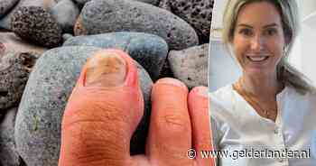 Wat helpt tegen kalknagels? ‘Middeltjes van de drogist zijn weinig zinvol’