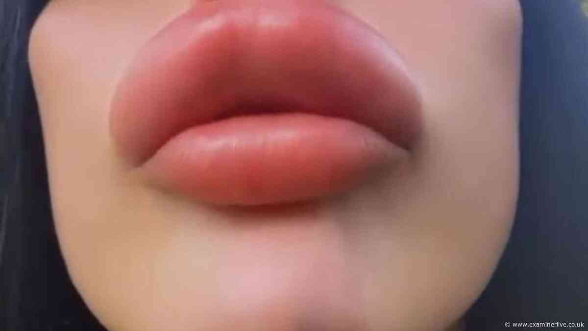 Manchester model self-injects lip filler at home after clinics refused over safety risks