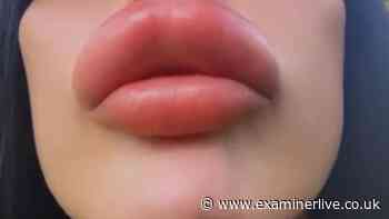 Manchester model self-injects lip filler at home after clinics refused over safety risks
