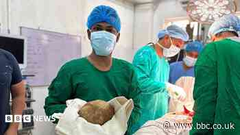 Doctors remove 3.1kg stone from man's bladder and claim record