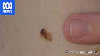 New 'landmark' drug shown to prevent recurrence of deadly melanoma
