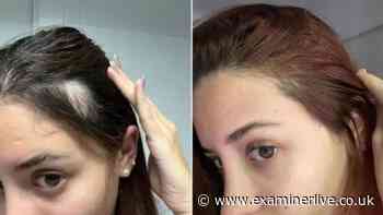 Woman 'no longer embarrassed' by thinning hair after using £29 serum for 3 months