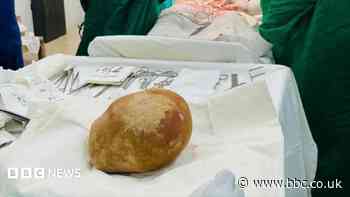 Doctors remove record-size bladder stone
