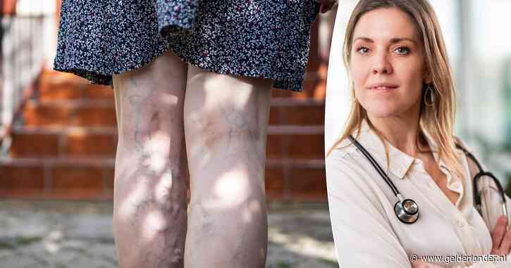 Zichtbare aders op benen kunnen op een aandoening wijzen: huisarts legt uit wanneer je naar de dokter moet