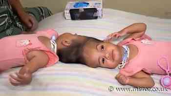 Conjoined twins die after final stage of complex separation surgery
