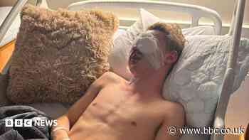 Teen blinded by firework wants ban on public sales