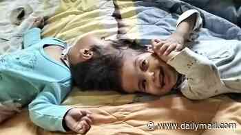 Conjoined twin girls, 2, die on operating table after fifth desperate surgery to separate them goes wrong