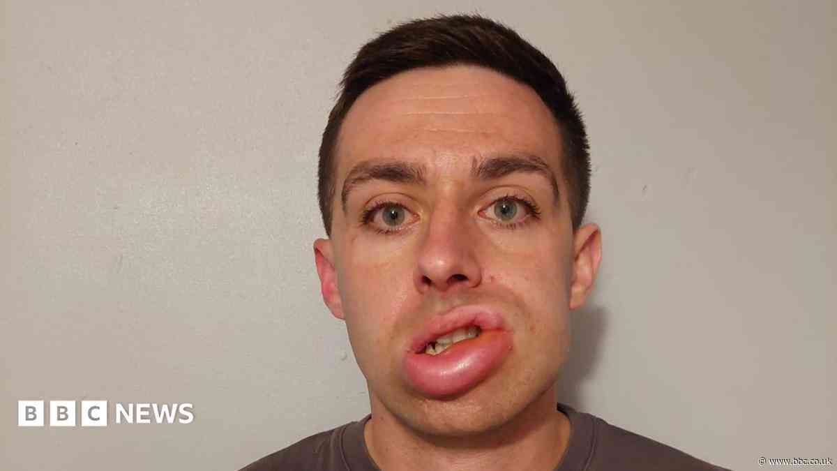I'd swell up once a week - now my life has changed