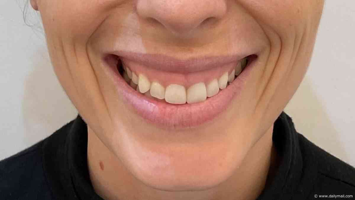 My gummy smile meant I always hid from photos or stopped myself laughing - until I found the five-minute solution. It's something I swore I'd NEVER do... but it finally has me grinning again
