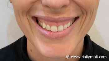 My gummy smile meant I always hid from photos or stopped myself laughing - until I found the five-minute solution. It's something I swore I'd NEVER do... but it finally has me grinning again