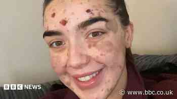 'My skin makes me unique and I'm learning to embrace it'