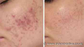 'Best product I've ever owned' is £30 gel that 'transformed my spot scarred skin'