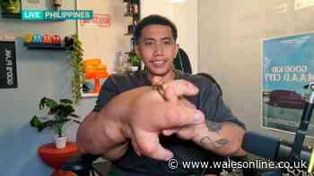 This Morning guest with 9kg hands feared his daughter would inherit rare condition