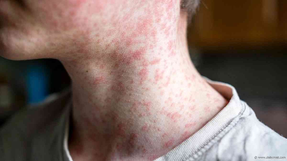 First measles deaths recorded of 2026... as cases reach highest level in more than three decades