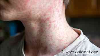 First measles deaths recorded of 2026... as cases reach highest level in more than three decades