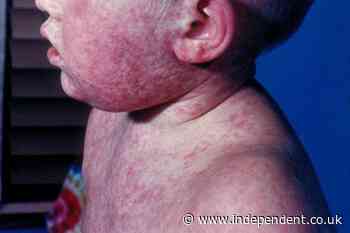 Pennsylvania reports first measles deaths in 35 years