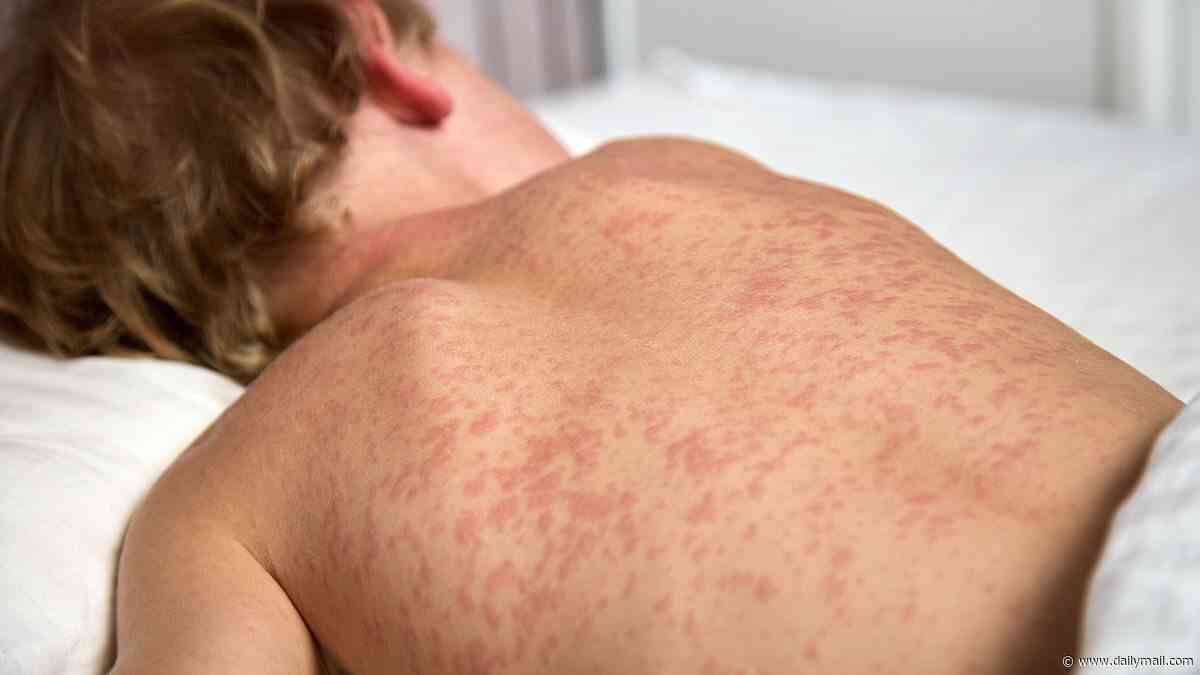Measles outbreaks in multiple states potentially exposes thousands... as US records first deaths this year