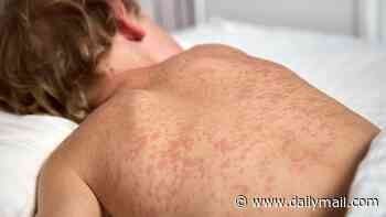 Measles outbreaks in multiple states potentially exposes thousands... as US records first deaths this year