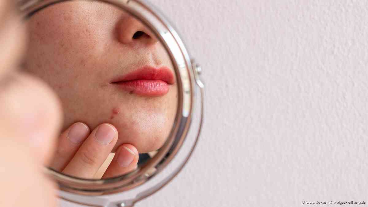„Ernsthafte Nebenwirkungen“: Hautarzt warnt vor Akne-Medikament Isotretinoin