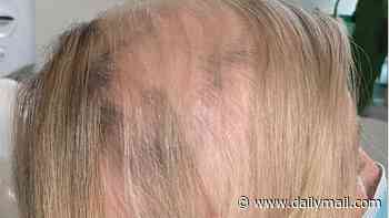I suddenly developed bald patches and spent thousands of pounds on every available solution. I was about to buy a wig when I found this miracle supplement that gave me better hair than ever - and it costs less than $1