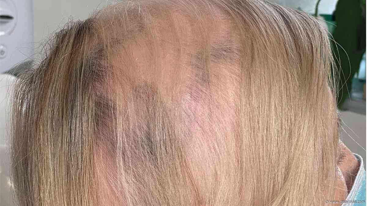 I suddenly developed bald patches and spent thousands of dollars on every available solution. I was about to buy a wig when I found this miracle supplement that gave me better hair than ever - and it costs less than $1