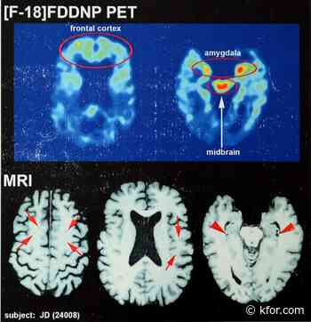 At least 1 in 4 former NFL players has CTE: Study