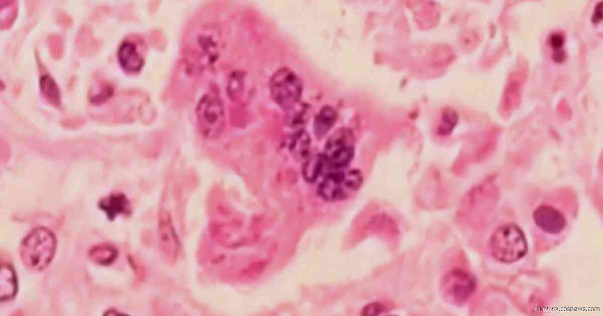 First measles deaths reported in the U.S. for 2026