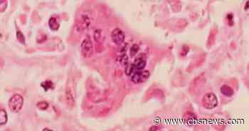First measles deaths reported in the U.S. for 2026