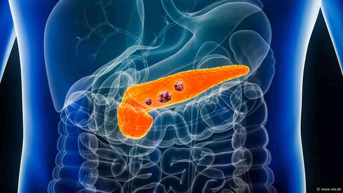 Verlängert Überleben: FDA lässt Medikament gegen Bauchspeicheldrüsenkrebs vorzeitig zu