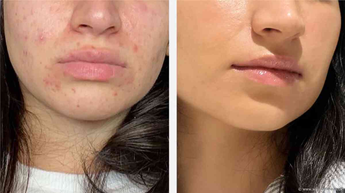 Spot and acne sufferers 'can't live without' doctor's gel dubbed 'Holy Grail'