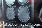 Cannabis, Cocaine, and Amphetamines Linked to Up to 174 Percent Higher Stroke Risk in Adults Younger Than 55