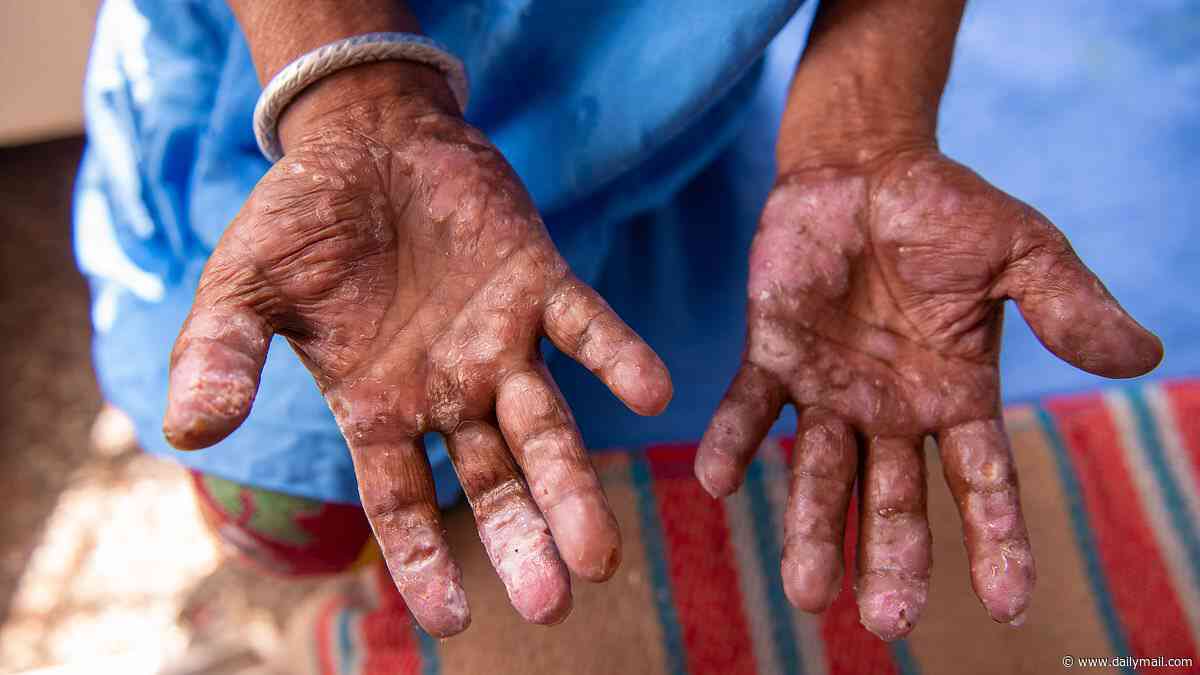 Deadly ancient disease is making a comeback in the US, experts warn... as they reveal the surprising reason why and how to protect yourself