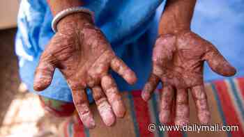 Deadly ancient disease is making a comeback in the US, experts warn... as they reveal the surprising reason why and how to protect yourself
