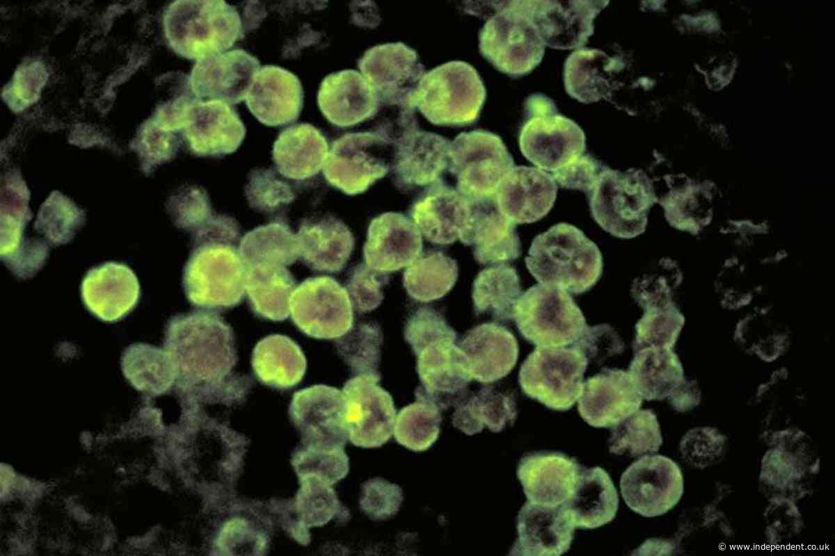 North Carolina teen critically ill after being infected ​with rare brain-eating amoeba