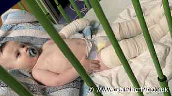 Baby left with second-degree burns after being burnt by bleach and hot water at nursery