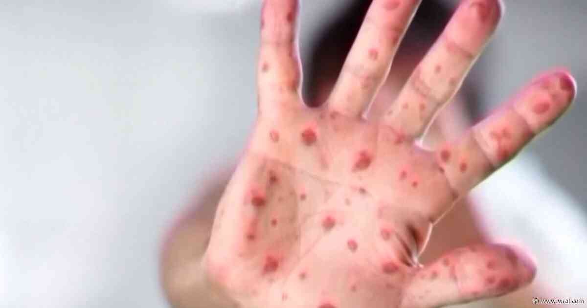 Fact-check: Did illegal immigration cause US measles outbreak?