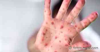 Fact-check: Did illegal immigration cause US measles outbreak?