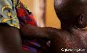 109 children die as measles spreads to 14 states