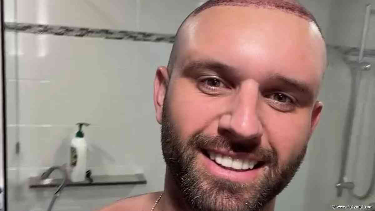 Married at First Sight groom Scott McCristal shares warning about hair transplant aftercare after treating his balding head