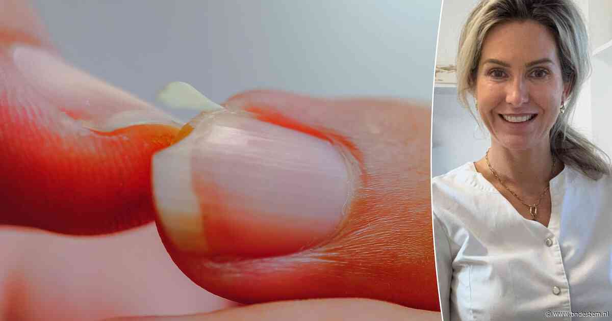Heb je dunne nagels die snel scheuren? Dit kan helpen volgens medisch pedicure