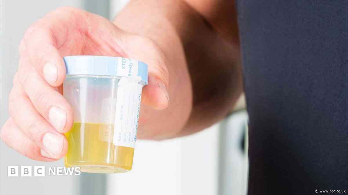 Urine test can spot more than nine in 10 bladder cancers