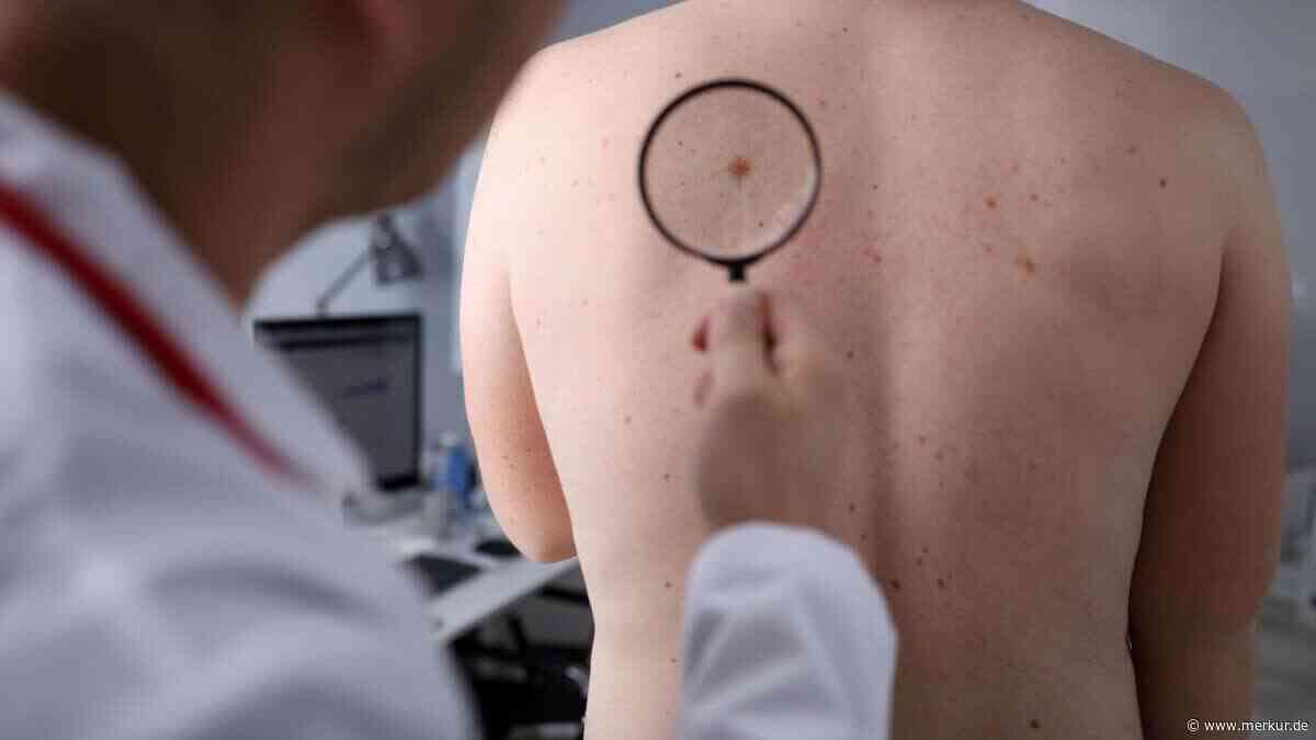 Revolutionärer Durchbruch bei Melanom: Neue Krebs-Therapie erhöht Überlebschancen