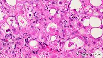 Doctors, liver specialist team up to better fight hepatitis in Alberta