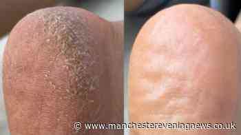 'Nothing seemed to fix my cracked heels - but one method made a vast improvement'