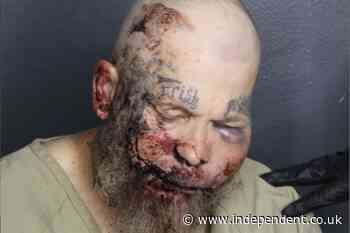Horrific mugshot shows injuries of Florida man who is accused of attacking cop in the hospital