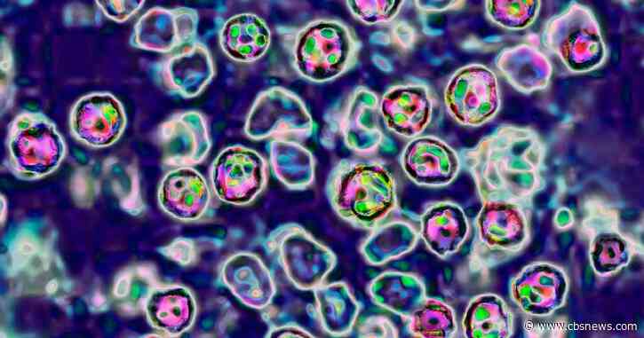 New measles cases associated with metro Atlanta day care outbreak confirmed, health officials say